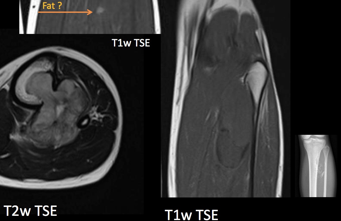 Figure 2 for case Dedifferentiated liposarcoma ( RID4360 )